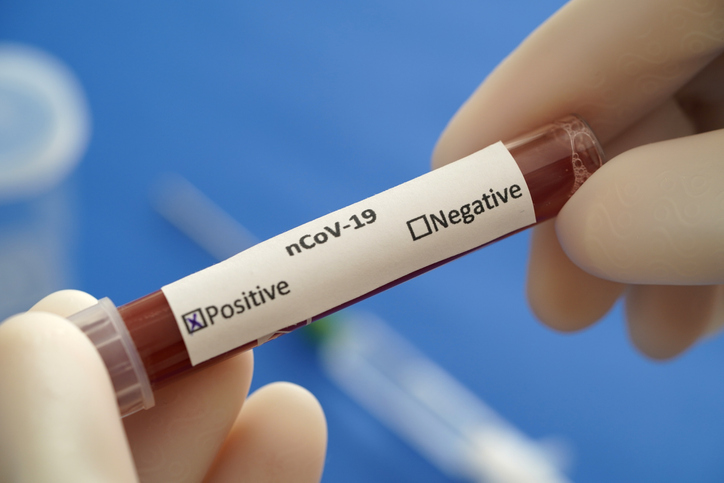 COVID19 test and laboratory sample of blood testing for diagnosis new Corona virus infection